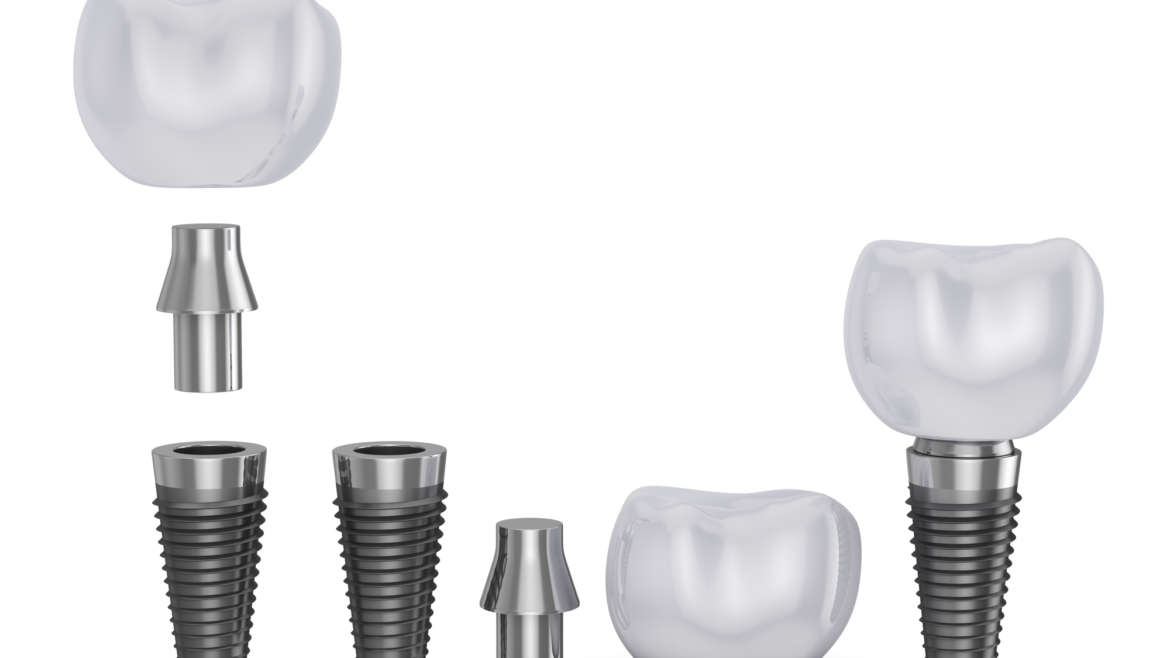 Implants